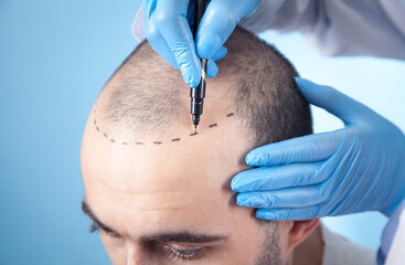 Hair transplant cost in Dubai