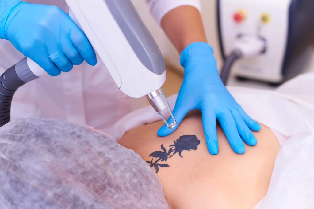 How Many Sessions Are Needed for Laser Tattoo Removal? 