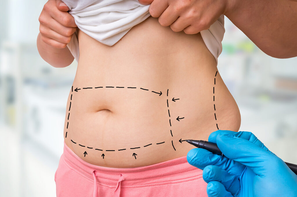 Liposuction Surgery in Dubai