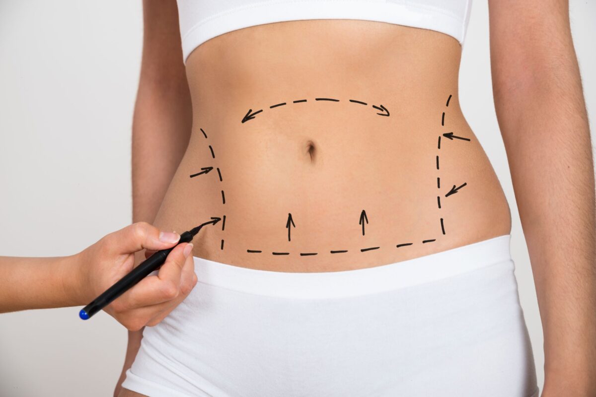 Liposuction versus Non-Careful Fat Expulsion: Which choice is best fir You?