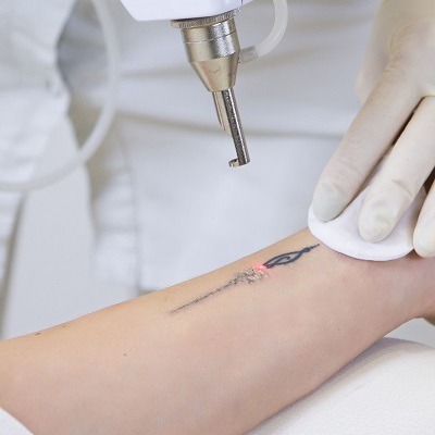 Essential Knowledge: Facts on Picosure Tattoo Removal in Dubai