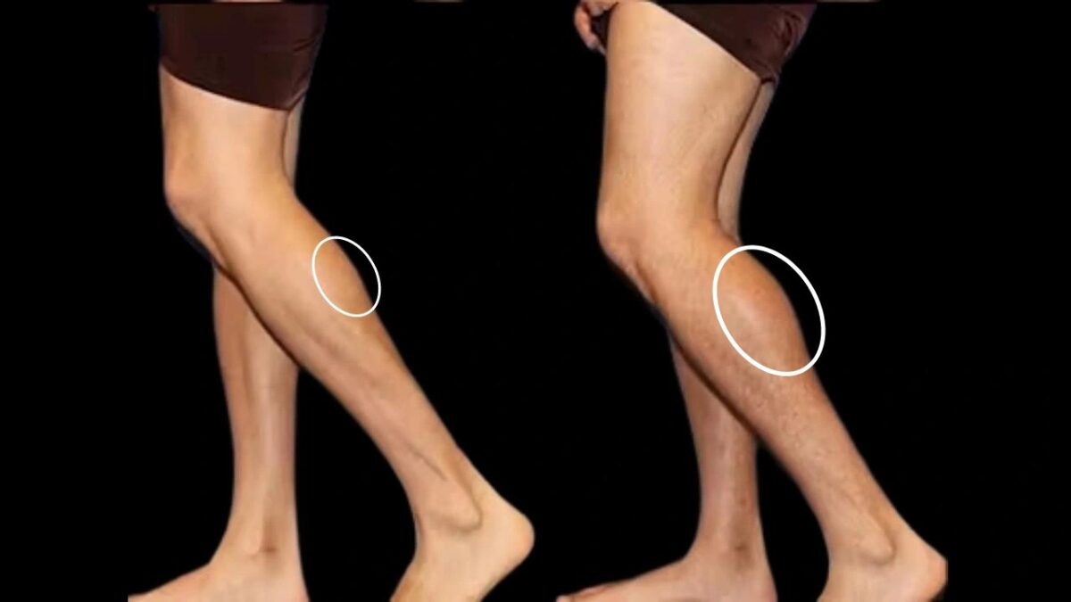 Refine Your Leg Shape with Calf Reduction Options