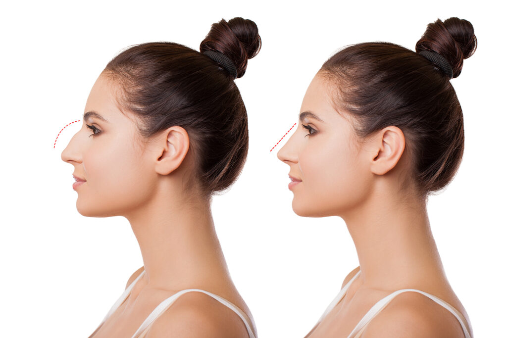 Rhinoplasty in Dubai