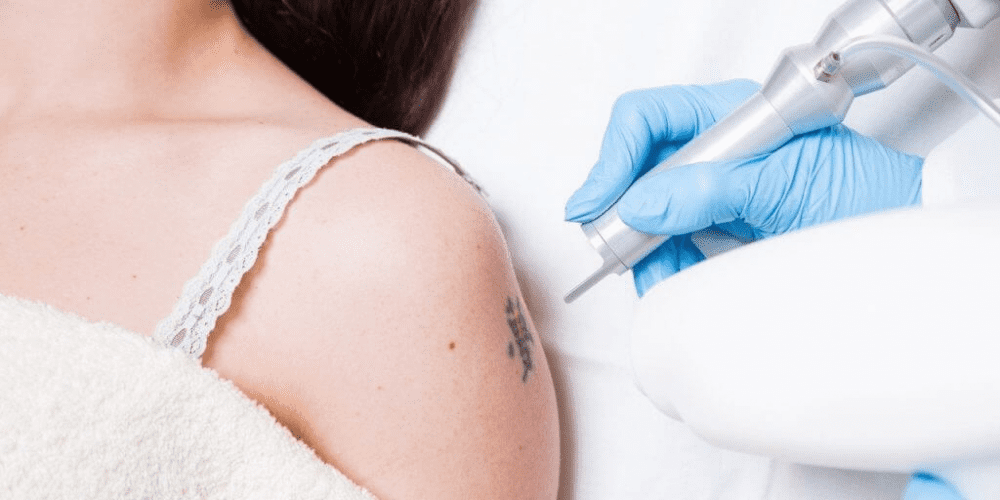 Picosure Tattoo Removal in Dubai