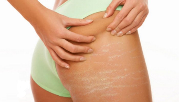 Transform Your Skin Stretch Marks Removal