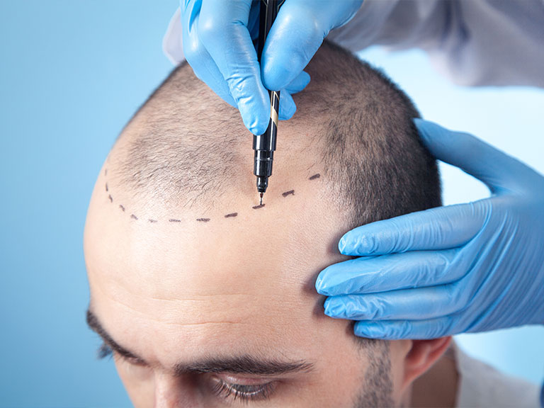 What Can I Expect During a Crown Hair Transplant Procedure? 