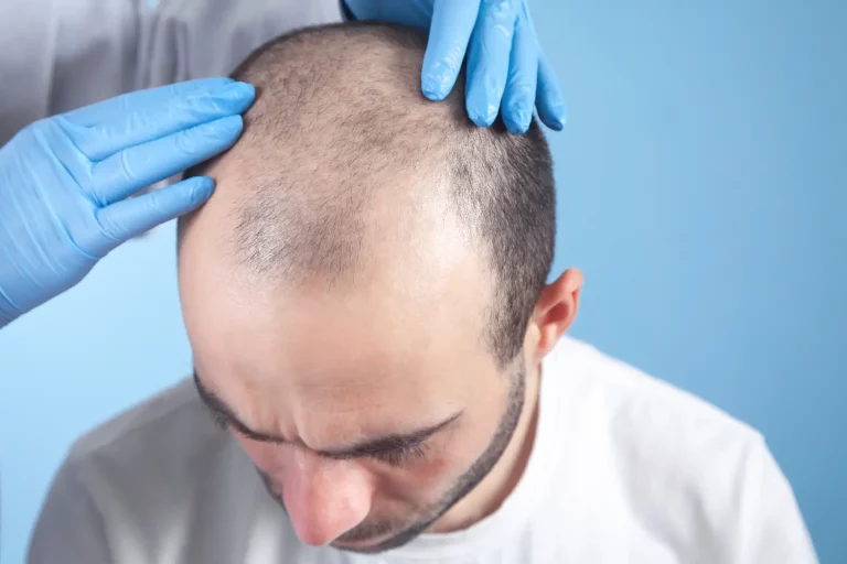 What Can I Expect During a Crown Hair Transplant Procedure?