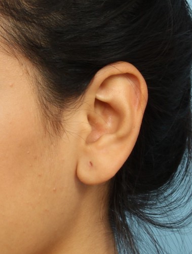 Who is a Good Candidate for Ear Reshaping?