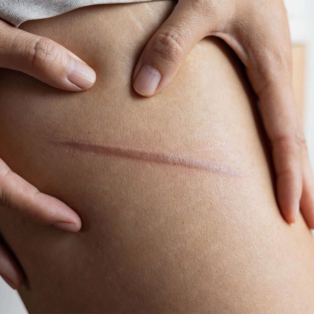 The Science Behind Laser Scar Removal Explained